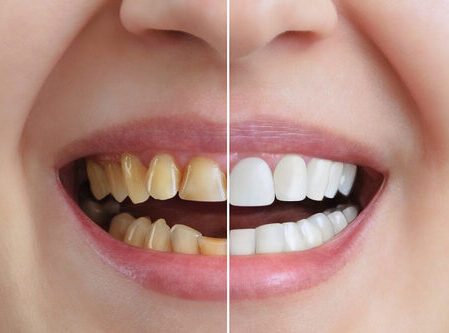 Teeth whitening in Delhi
