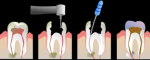 Root Canal Treatment