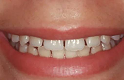 Dental Veneers in Delhi - Best Dental Veneers in India - 32 Strong