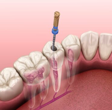 Root Canal Treatment Specialist In Delhi. 32 Strong Dental
