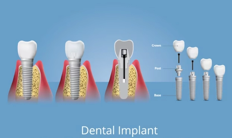 Painless Rct Painless RCT in Delhi - 32 Strong Dental