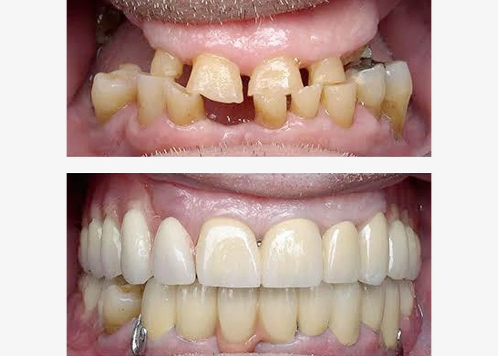 Full Mouth rehabilitation