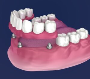 All-on-4-dental implants