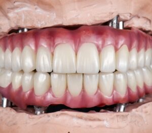 All-on-6 dental implants