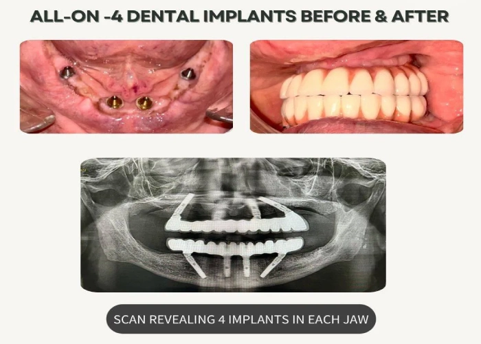 All-On-4 Dental Implants