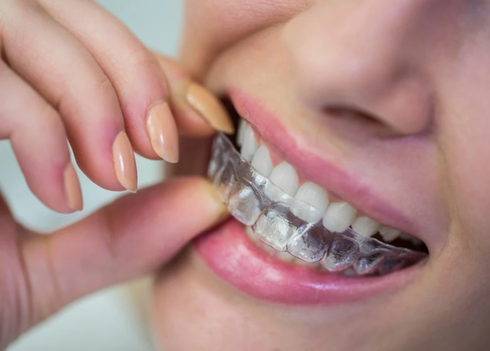 Invisible Braces