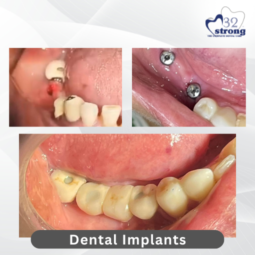 Dental Implant