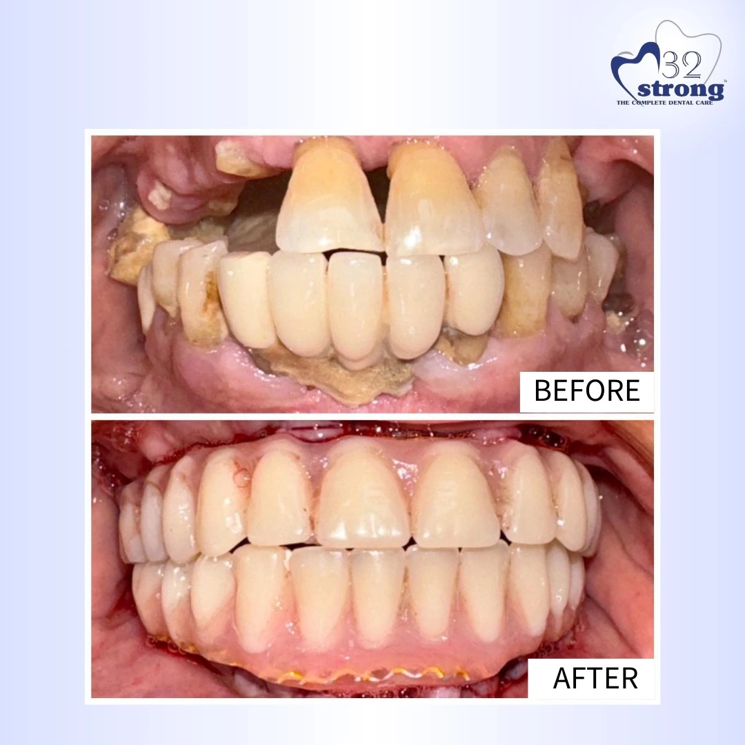 Full Mouth Rehabilitation In Delhi