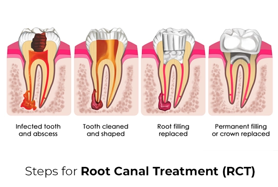 Preserving Natural Teeth through Root Canal Treatment in Delhi