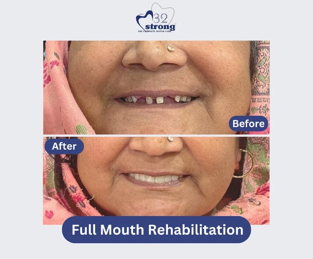 Full Mouth Rehabilitation