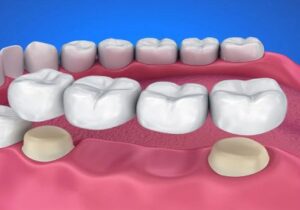 benefits of dental bridges